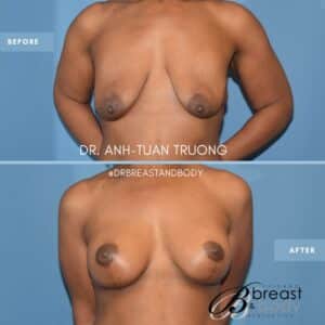 breast lift scarring