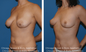 breast lift mastopexy surgical scars