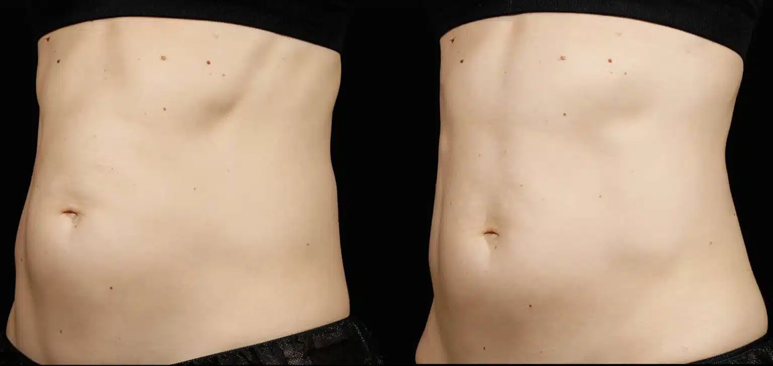 Before-After-SculpSure-Flanks-and-Abdomen-3-1-1-1536x727 copia