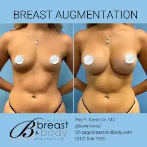Breast Augmentation Chicago copia copia