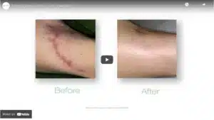 scar reduction and removal