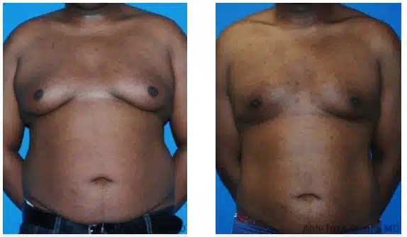 Chicago-gynecomastia-male-breast-reduction copia