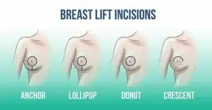 How is a breast lift done copia