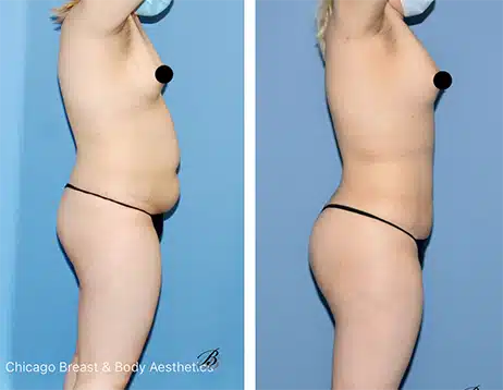 Is-360-liposuction-painful copia