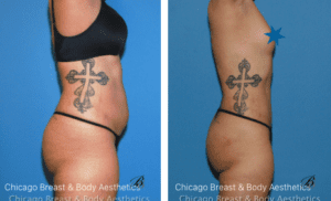 Is liposuction safe?