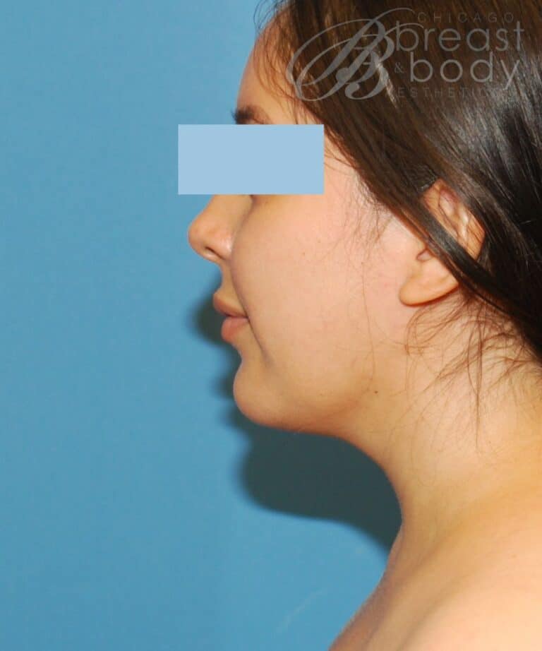 After NeckSculpt neck liposuction photo, case 1605899, patient of Dr. Anh-Tuan Truong, side profile