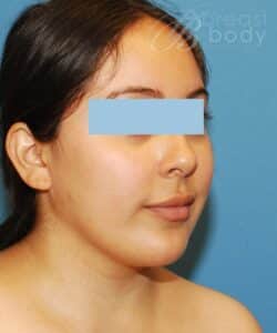 neck sculpt submental liposuction before after by Dr. Truong Chicago Breast And Body Aesthetics