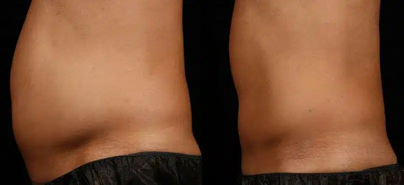 SculpSure-Male-Before-After-810x371-1 copia
