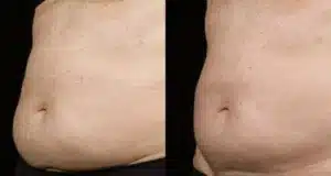 SculpSure Tummy Reduction copia