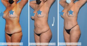 Tummy Tuck vs Liposuction Before And After Photo - Chicago Breast And Body Aesthetics