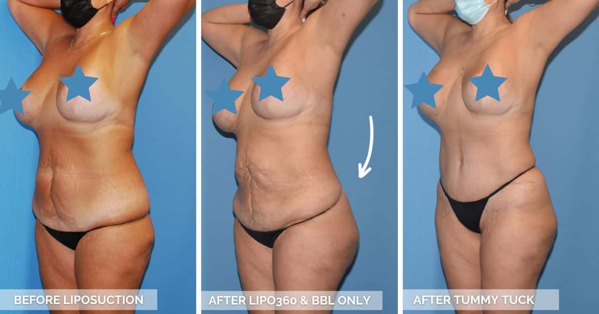Tummy Tuck vs Liposuction Before And After Photo - Chicago Breast And Body Aesthetics