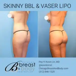 Skinny Brazilian Butt Lift 1536x1536 copia