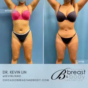 best liposuction 360 copia