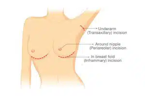 breast implant incision placement chicago breast and body 300x199 copia