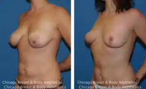 breast lift surgery scars photo copia