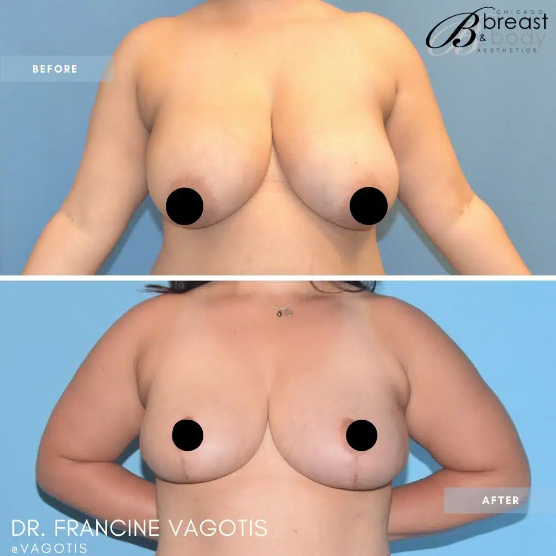 breast-reduction-and-lift-surgery copia