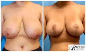 breast reduction surgeon chicago 2048x1228 copia