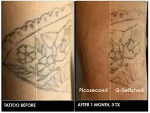 chicago tatto removal after one month copia