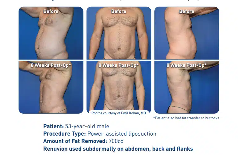 jplasma-liposuction-before-after-abdomen-chicago copia