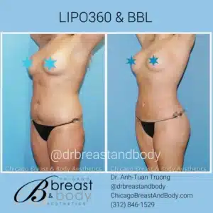 liposuction 360 picture chicago copia