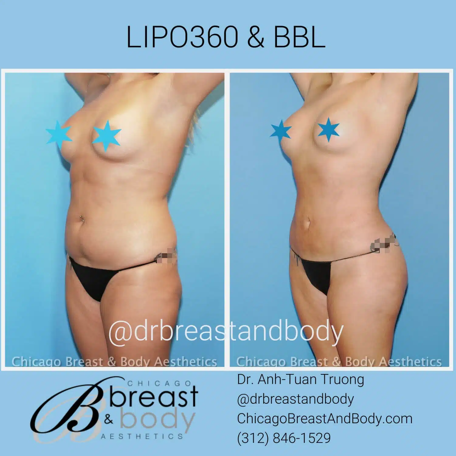 liposuction-360-picture-chicago copia