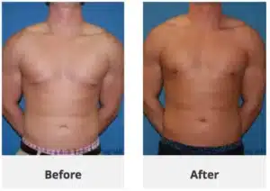male breast reduction surgery done by dr truong copia