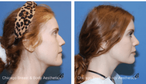 before and after rhinoplasty nose surgery - chicago breast and body aesthetics