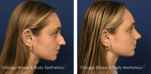 before and after rhinoplasty by Dr. Francine Vagotis Chicago Breast & Body