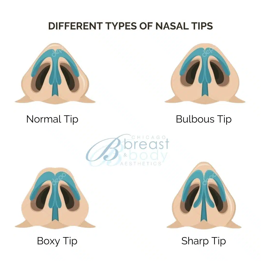 nose types