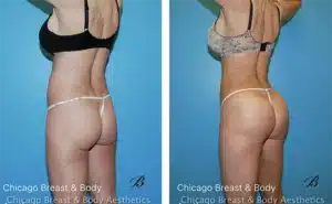 skinny bbl before after photos chicago truong1 copia 1