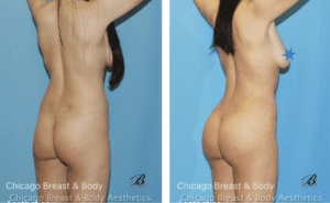 skinny bbl before after photos chicago truong2