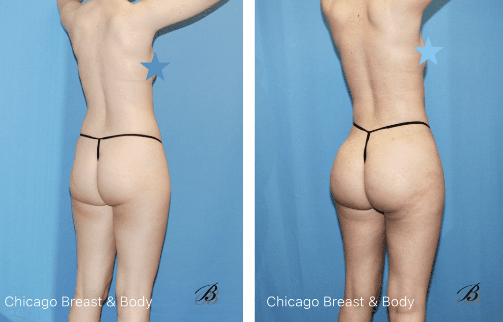 Skinny bbl brazilian butt lift before and after photos