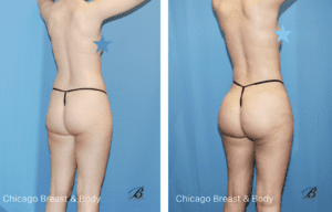 skinny bbl before after photos chicago truong3