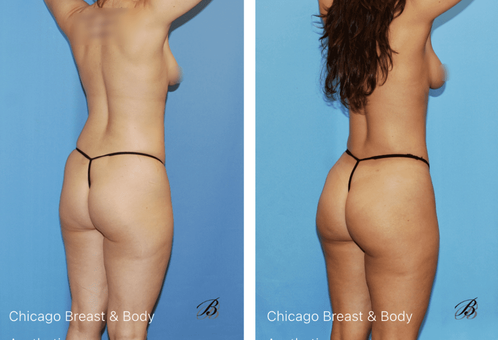 Skinny bbl brazilian butt lift before and after photos