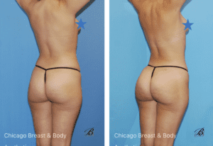 skinny bbl before after photos chicago truong5