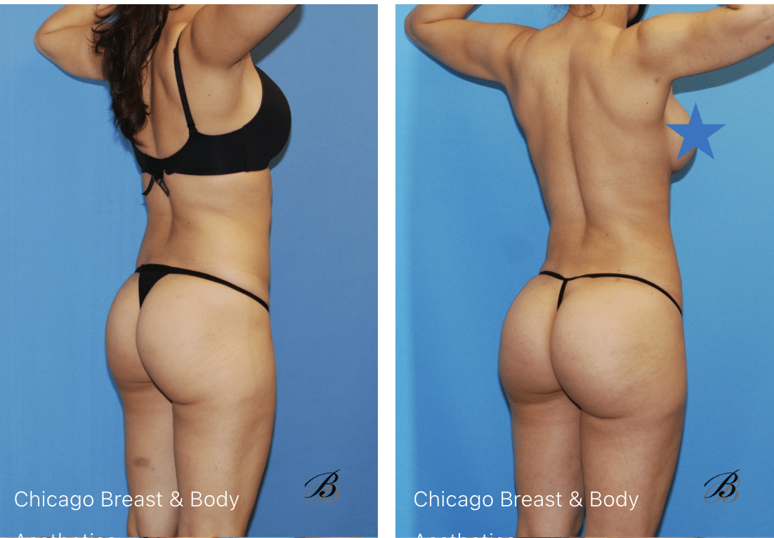 best bbl surgeon in chicago illinois