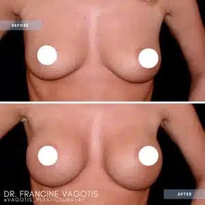vagotis breast augmentation copia