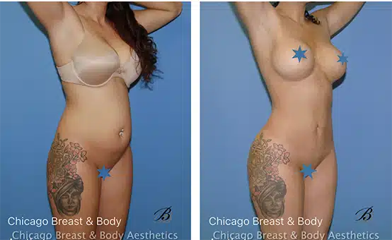 what-is-tumescent-liposuction copia