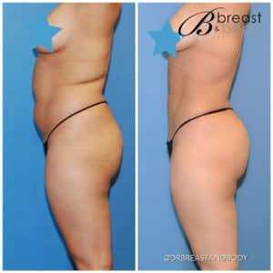 lipo 360 liposuction before after photos chicago breast and body
