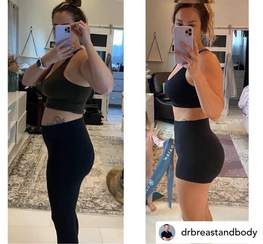 #1 Skinny BBL & Natural Brazilian Butt Lift