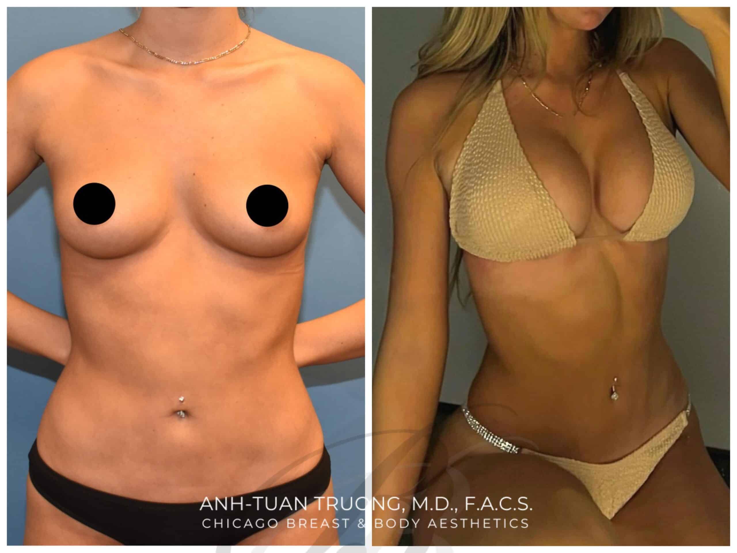 Dr. Anh Tuan Truong Reviews Chicago Breast & Body
