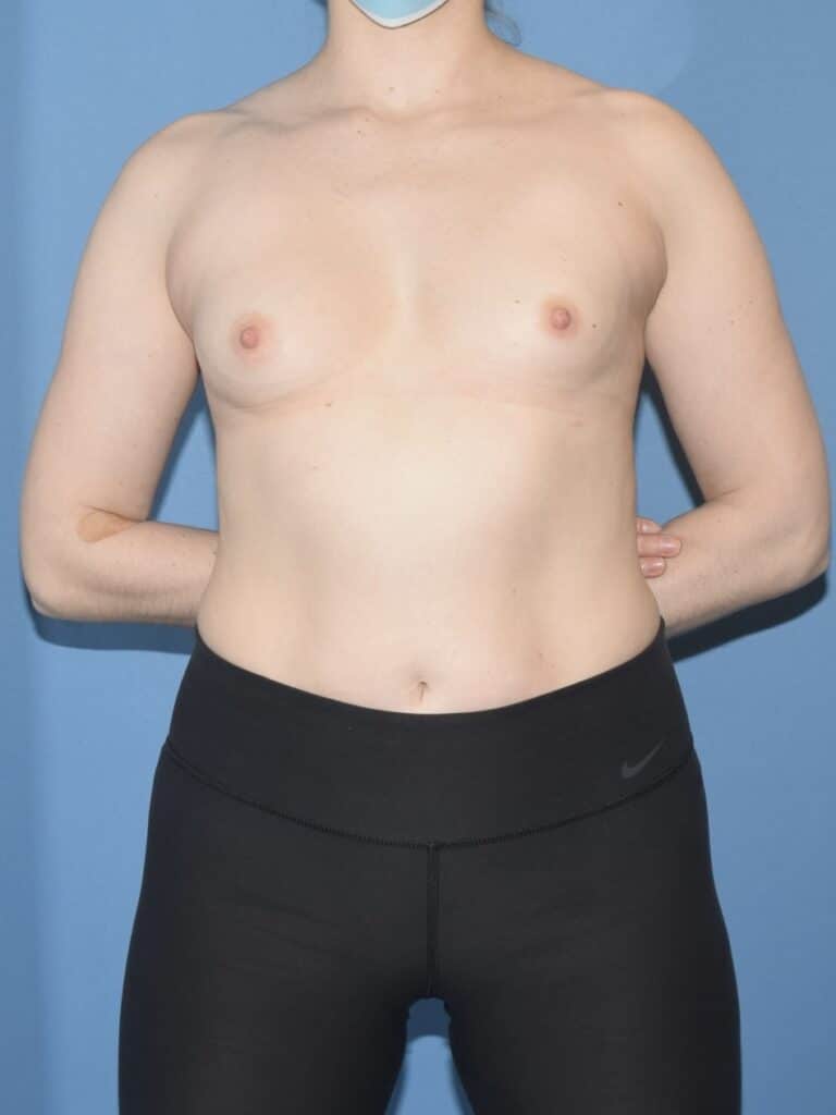 breast-augmentation-chicago-dr-vagotis