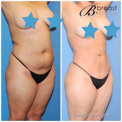 360 liposuction before after photos - Lipo 360