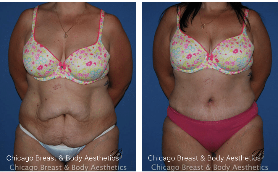 plus size tummy tuck before and after case 95