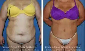 plus size tummy tuck chicago before after photo case 197 copia 1