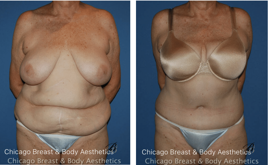 plus size tummy tuck photos before after case 94 2