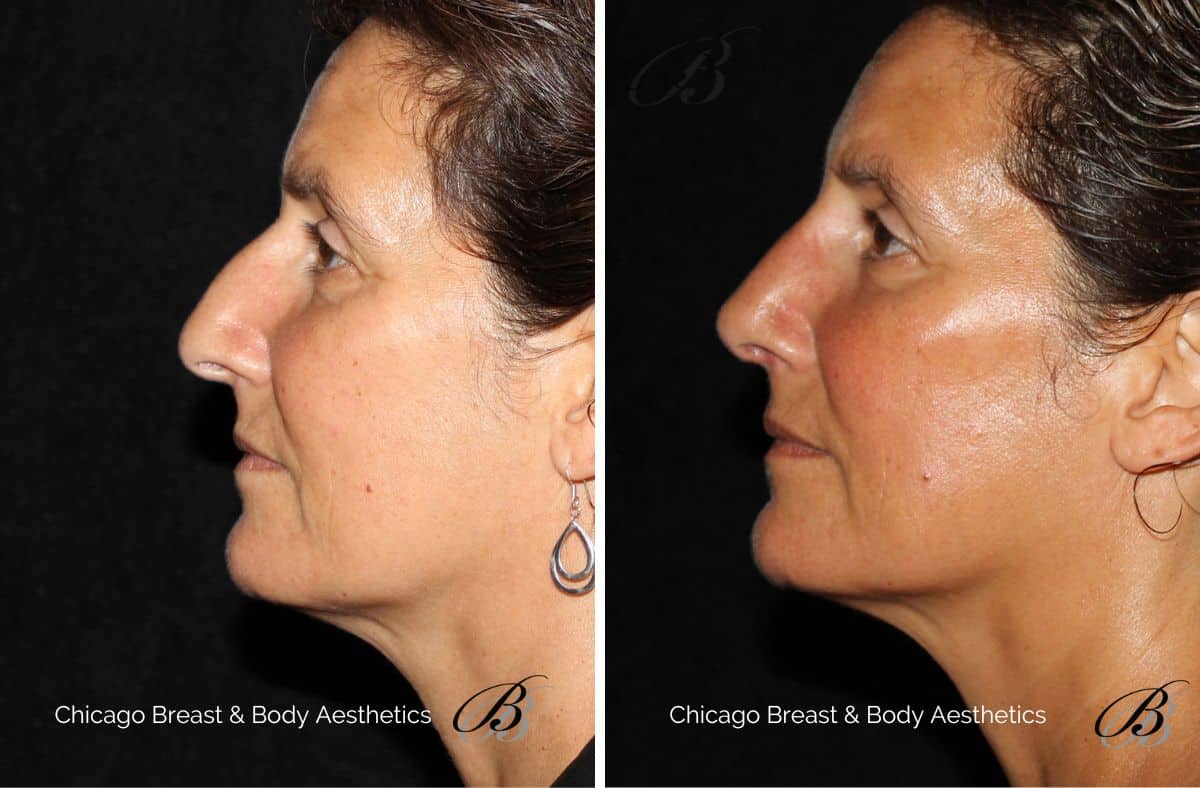 how is nose surgery peformed - before and after photo