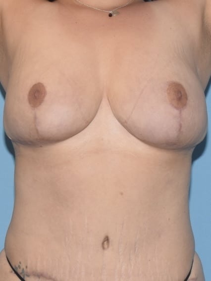 breast-reduction-surgery-chicago