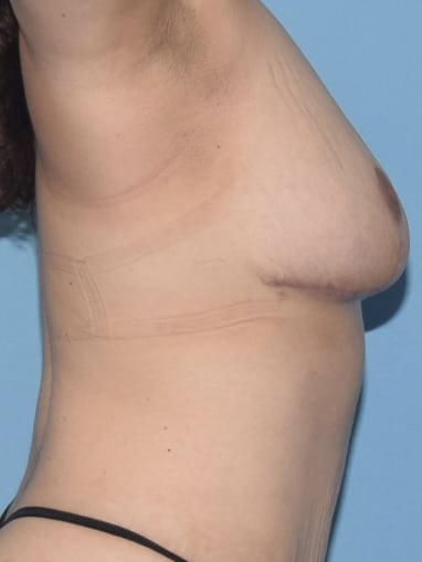 breast-reduction-surgery-chicago