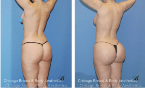 lipo360 and bbl before and after - chicago breast and body aesthetics